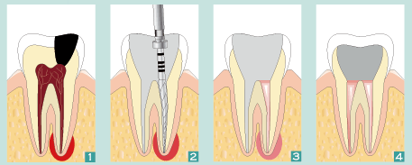 La dévitalisation (traitement endodontique) – Docteurs Martinet